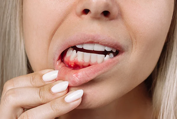 Bleeding Gums and Gum Disease