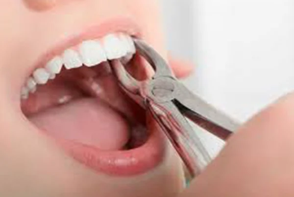 Dental Extractions