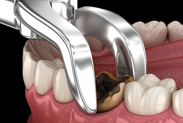Wisdom Teeth Removal