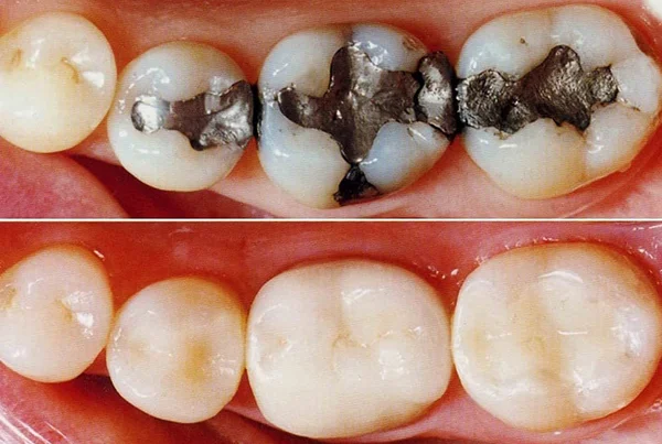 Tooth Coloured Fillings